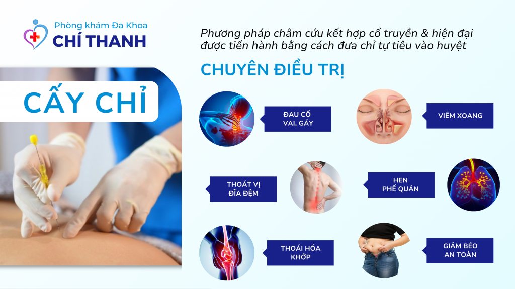 Tác Dụng Phụ Của Cấy Chỉ